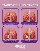 Image result for Lung Tumor 7Cm