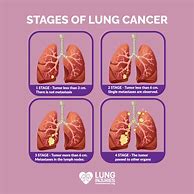 Image result for Lung Tumor 7Cm