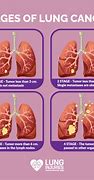 Image result for Lung Cancer Tumor