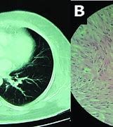 Image result for Ground Glass Pulmonary Nodule