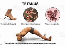 Image result for Tetanus Infection