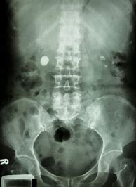 Image result for 6 mm Kidney Stone Image