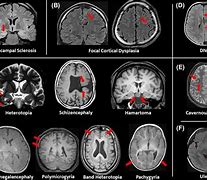 Image result for Focal Seizure Arm