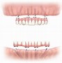 Image result for All On 4 Dental Implants