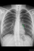 Image result for 4 View Chest X-Ray