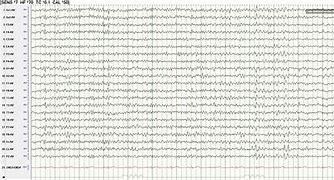 Image result for Normal EEG Tracing