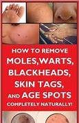 Image result for Wart Removal by Pliers