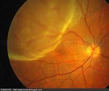 Image result for Retinal Detachment Fundus