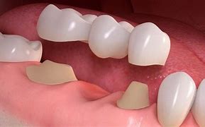 Image result for Dental Bridge Example