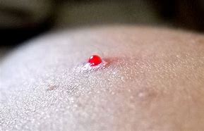 Image result for Scab Blood Dots