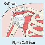 Image result for Rotator Cuff Muscles Injury