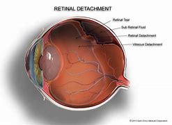 Image result for Retinal Detachment Diagram
