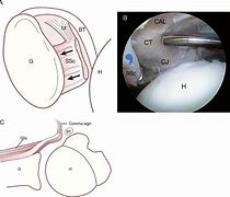 Image result for Shoulder Subscapularis Tendon Tear