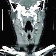 Image result for Tonsil Necrosis