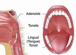 Image result for adenopwt�a