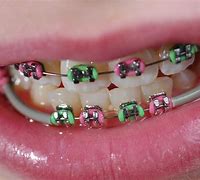 Image result for Cool Braces Ideas