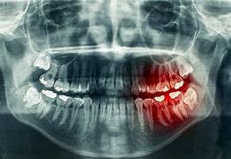 Image result for Jaw Bone Cancer
