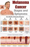Image result for Skin Cancer Metastasis Symptoms