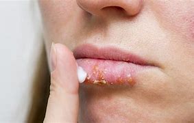 Image result for Chapped Lips From Cold Wind