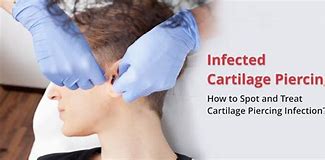 Image result for infected cartilage