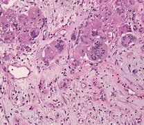 Image result for Multinucleated Giant Cells
