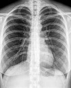 Image result for X-ray of Ribs