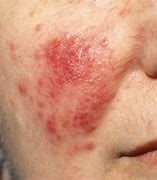 Image result for Red Rashes On Skin