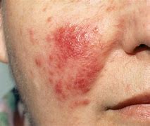 Image result for Red Blotches On Skin