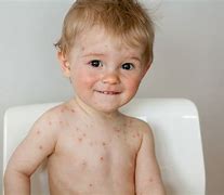 Image result for Chickenpox Blisters