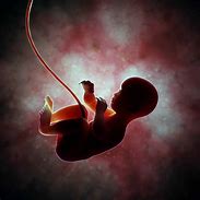 Image result for Intrauterine Fetal Death Anencephaly