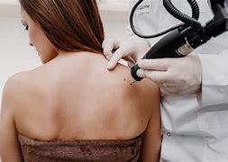 Image result for Cryotherapy for Molluscum Contagiosum