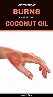 Image result for Coconut Oil Sun Burn