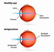 Image result for Eye Astigmatism Visualization
