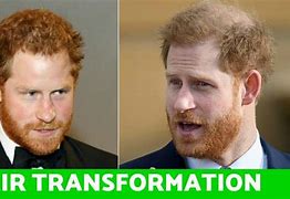 Image result for Prince Harry Thinning Hair