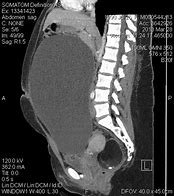 Image result for Septated Ovarian Cyst
