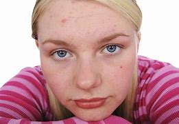 Image result for Teenager with Pimples Picture