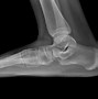 Image result for OS Peroneum Fracture vs Syndrome