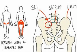 Image result for Sacroiliac Joint Dysfunction Pain