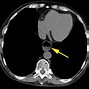 Image result for Esophagus CT