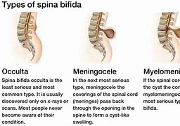 Image result for Spina Bifida in Adults