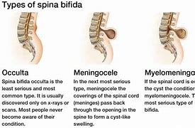 Image result for Spina Bifida Vertebra