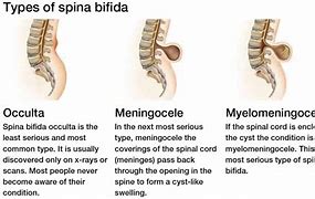 Image result for Spina Bifida Adult