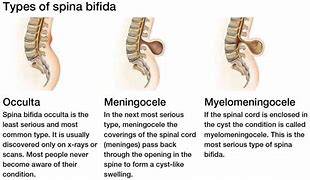 Image result for Spina Bifida Malformation