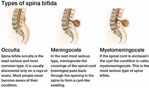 Image result for Spina Bifida S1
