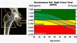 Image result for Osteoporosis Bone Density Chart