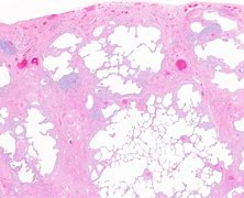 Image result for Pleuroparenchymal Tethering