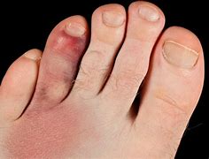 Image result for Smashed Foot Injury