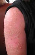 Image result for Best Sunburn Relief
