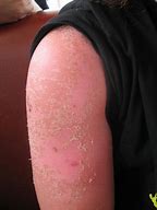 Image result for Severe Sunburn
