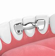 Image result for 4 Types of Dental Bridge